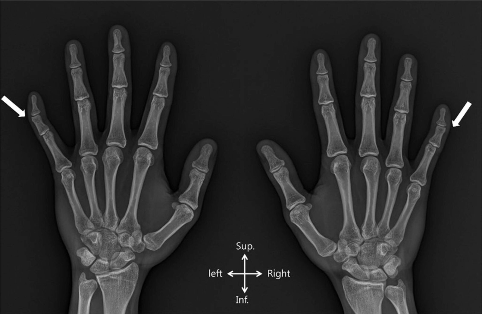 Clinodactyly is an autosomal dominant trait that has variable expressiveness and incomplete penetrance.