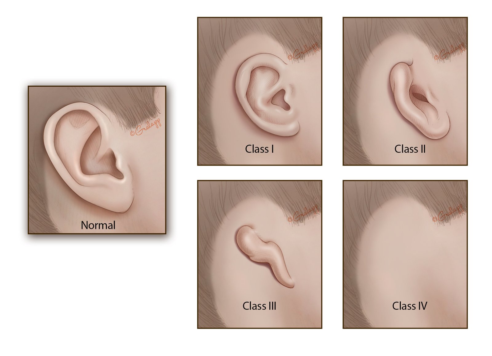 Microtia is a congenital deformity where the auricle (external ear) is underdeveloped. A completely undeveloped pinna is referred to as anotia. Because microtia and anotia have the same origin, it can be referred to as microtia-anotia. Microtia can be unilateral (one side only) or bilateral (affecting both sides). Microtia occurs in 1 out of about 8,000–10,000 births. In unilateral microtia, the right ear is most commonly affected. It may occur as a complication of taking Accutane (isotretinoin) during pregnancy.