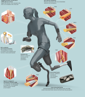 Prosthetic are devices designed to support users who are missing part of a body. They can be used by individuals who have lost a limb due to an injury, accident, or illness, and also by people who have a limb difference due to a congenital condition.