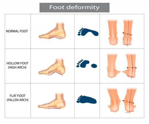 Flatfeet is a common condition, also known as flatfoot, in which the arches on the inside of the feet flatten when pressure is put on them.