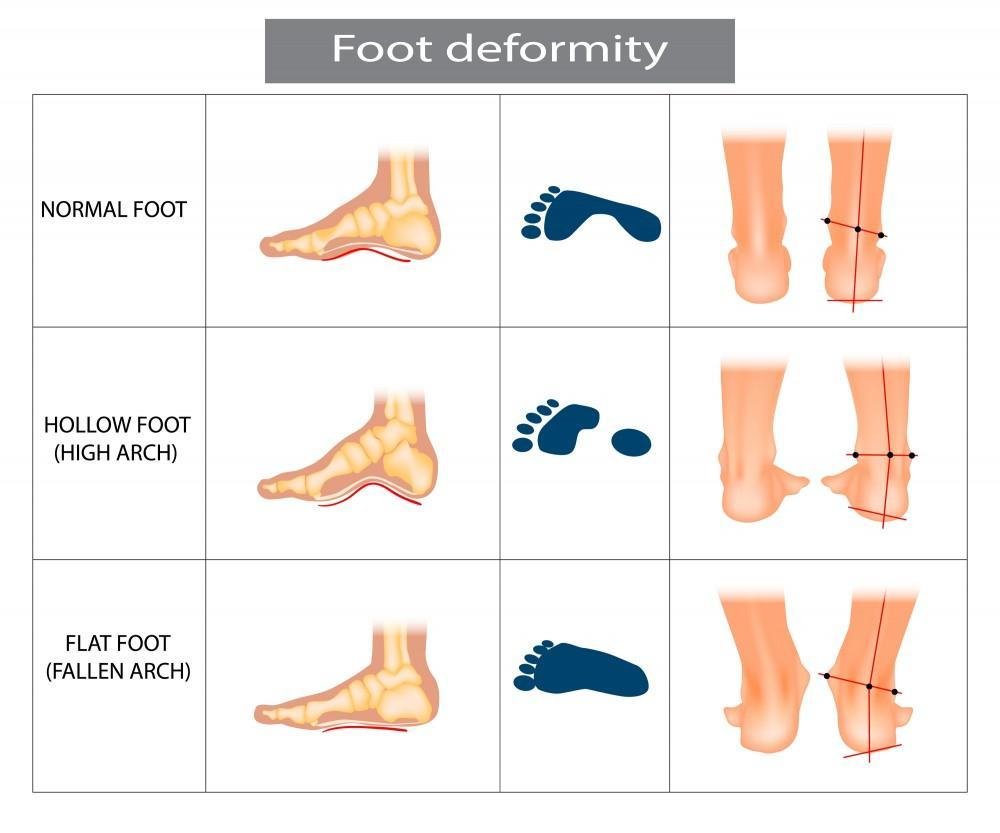 Flat feet mean the arches in the feet don't develop or collapse (fallen arches). Treatments can ease pain from flat feet.