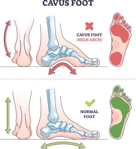 High arch feet may be genetic, or they may be caused by a number of underlying conditions.