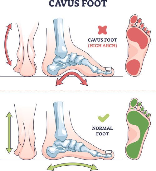 High arch feet may be genetic, or they may be caused by a number of underlying conditions.