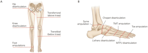Amputation is the loss or removal of a body part such as a toe, foot, or leg.