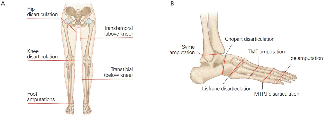 Leg or foot amputation is the removal of a leg, foot, or toes from the body. These body parts are called extremities. Amputations are done either by surgery or they occur by accident or trauma to the body.
