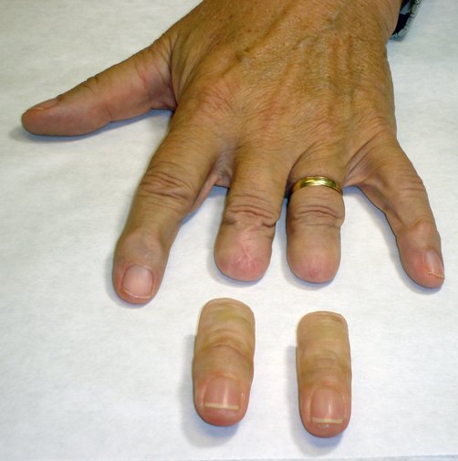 Prótesis para dedo - Somatoprótesis de silicona para dedo