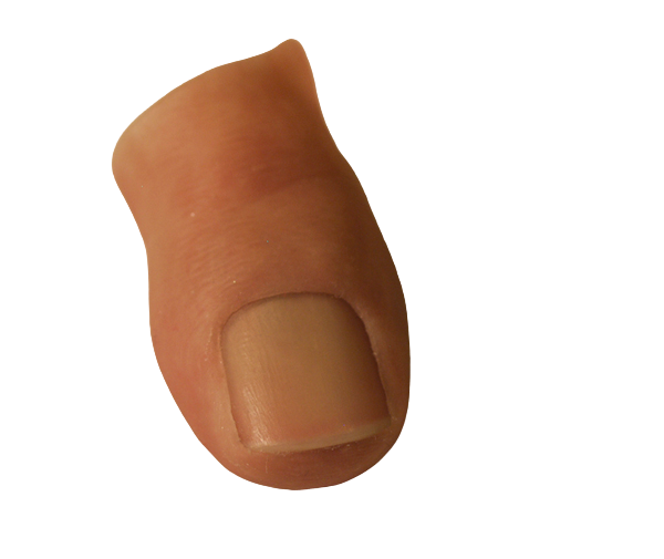 Prótesis para el dedo gordo del pie - desde la falange distal - Prótesis para el Dedo Gordo del pie
