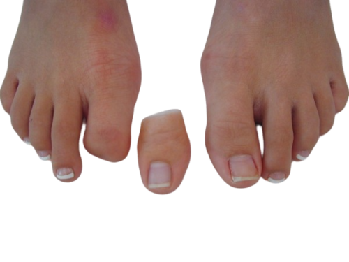 Prótesis para el Dedo Gordo o Hallux - Prótesis para el Dedo Gordo del pie