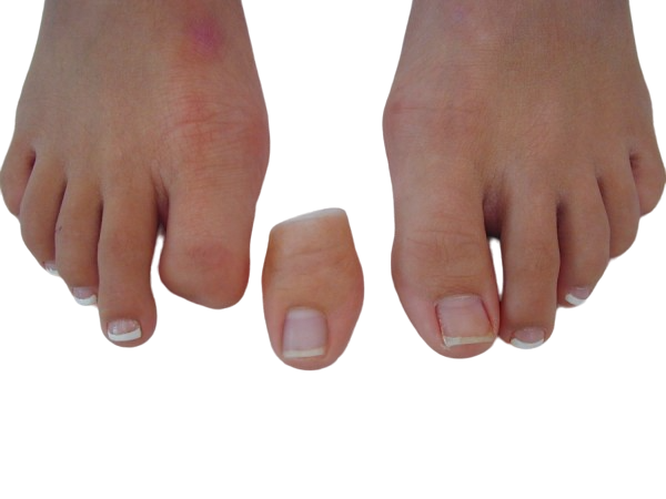 Prótesis para el Dedo Gordo o Hallux - Prótesis para el Dedo Gordo del pie