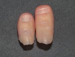dedo-pie - Somatoprótesis de Silicona para Dedo del Pie