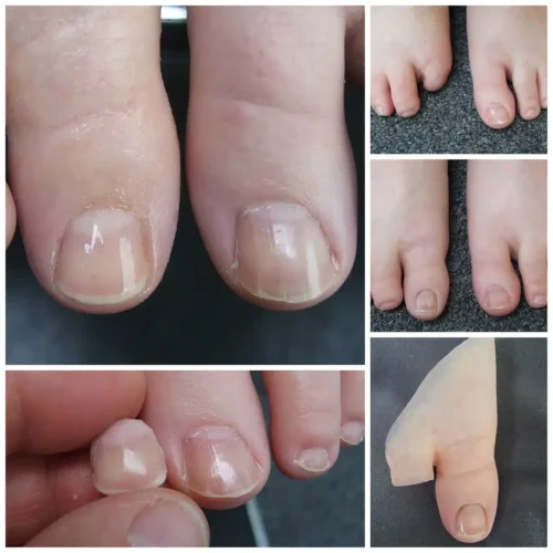 Prótesis Estéticas Para Los Dedos Del Pie