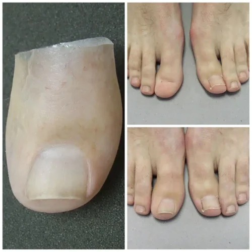 Prótesis Estéticas Para Los Dedos Del Pie